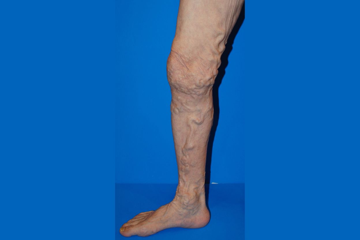 Varicose veins diagram showing enlarged twisted veins in legs